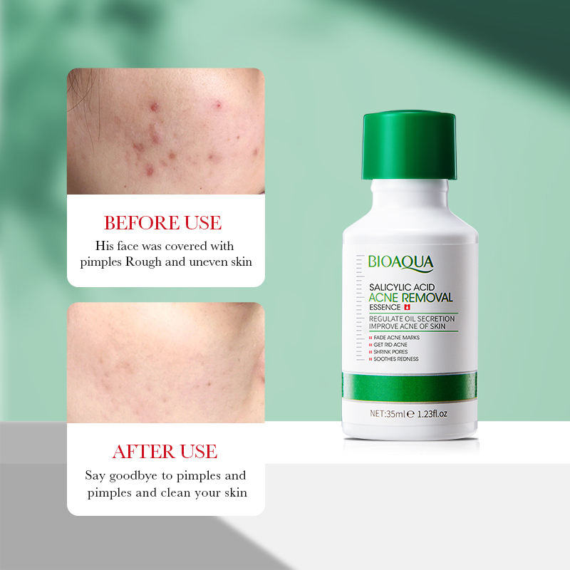 35ml BIOAOUA Salicylic Acid An - Salicylic Acid Blackhead Remover 评论和价格
